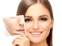 Achieve Clear Skin with our Effective Acne Treatment and Prevention Tips